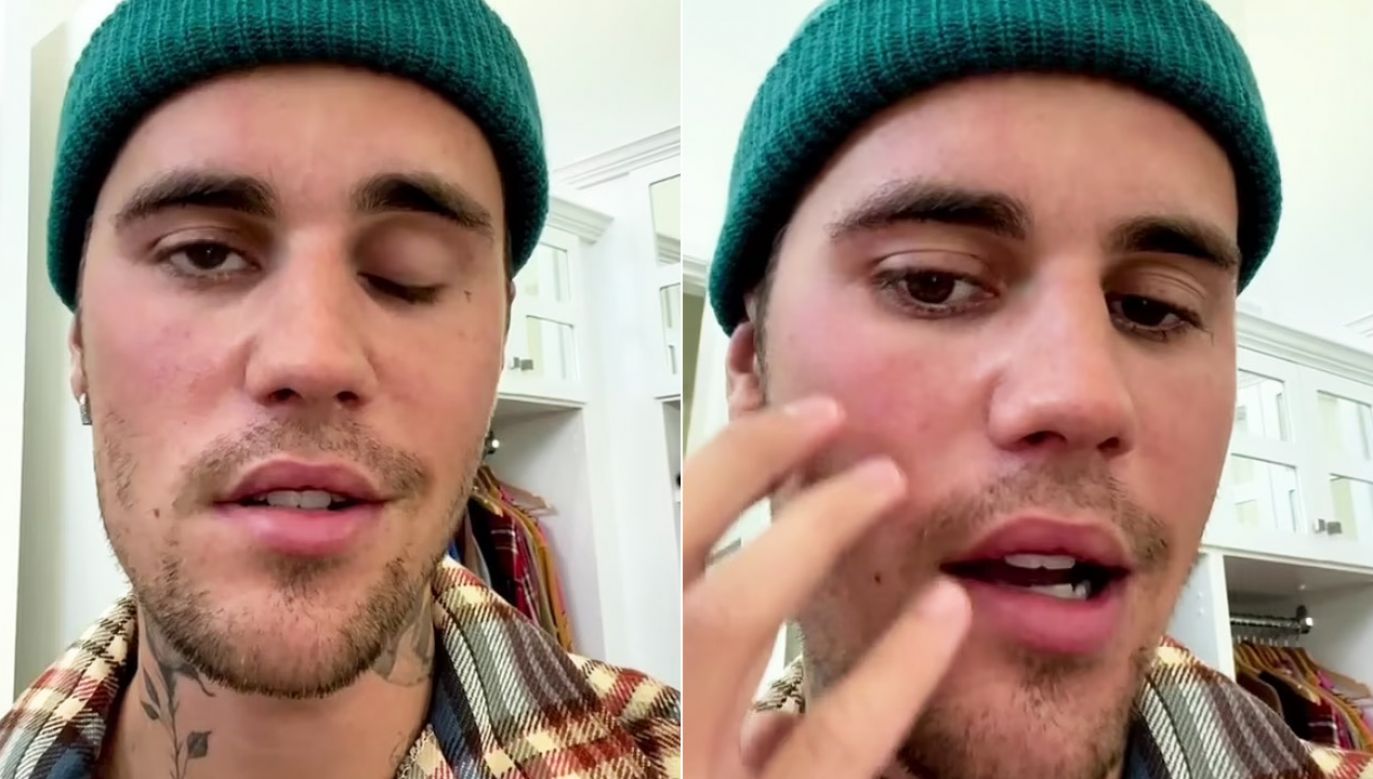 Wirus spowodował u Justina Biebera porażenie części mięśni twarzy (fot. Instagram/ Justin Bieber)